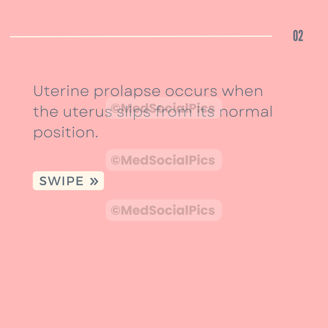 Uterine Prolapse