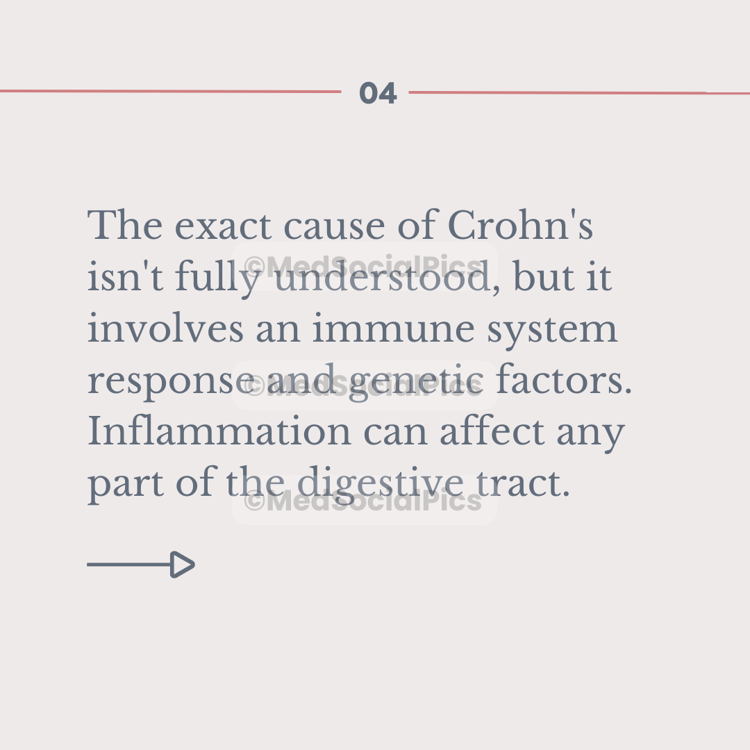 Crohn's Disease
