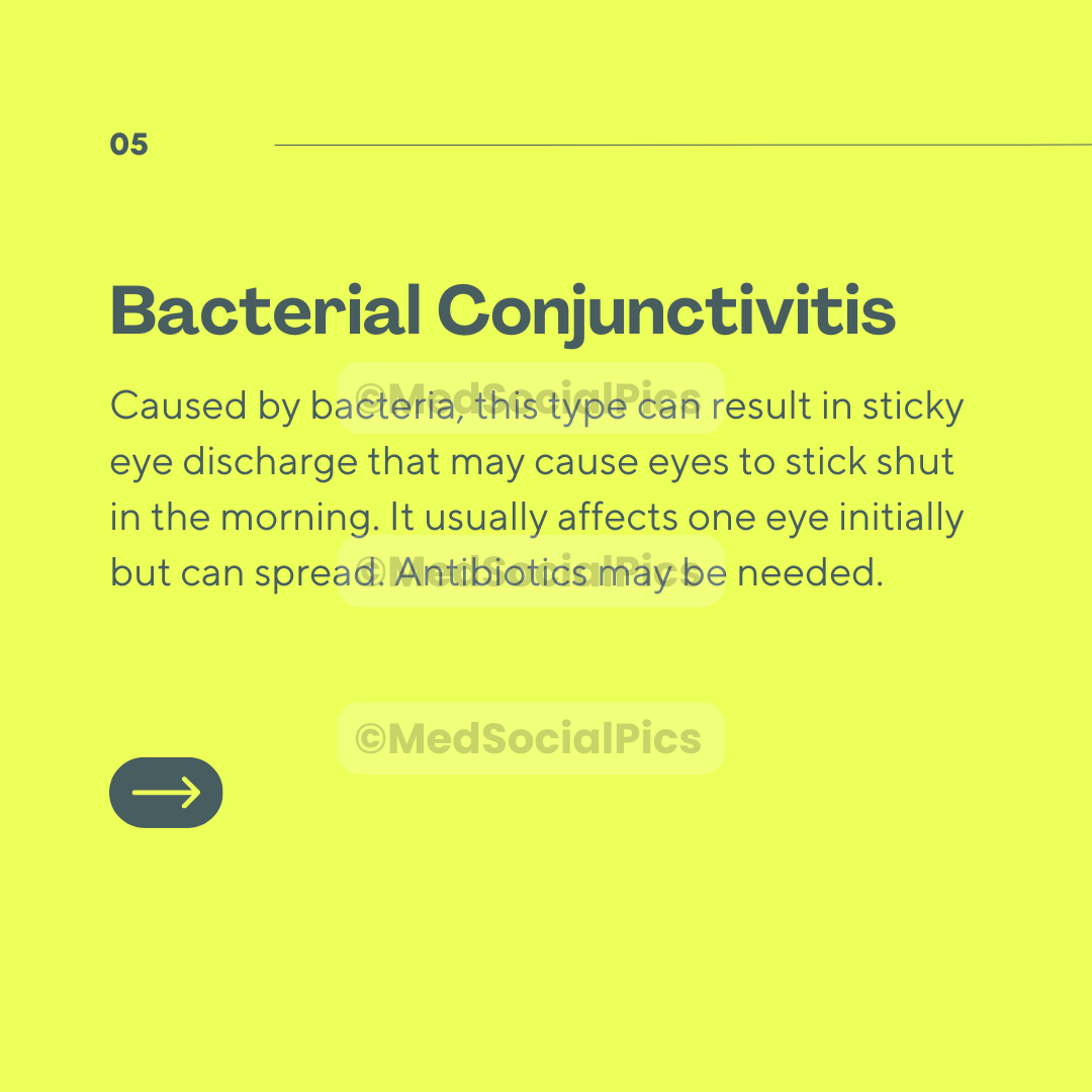 Conjunctivitis